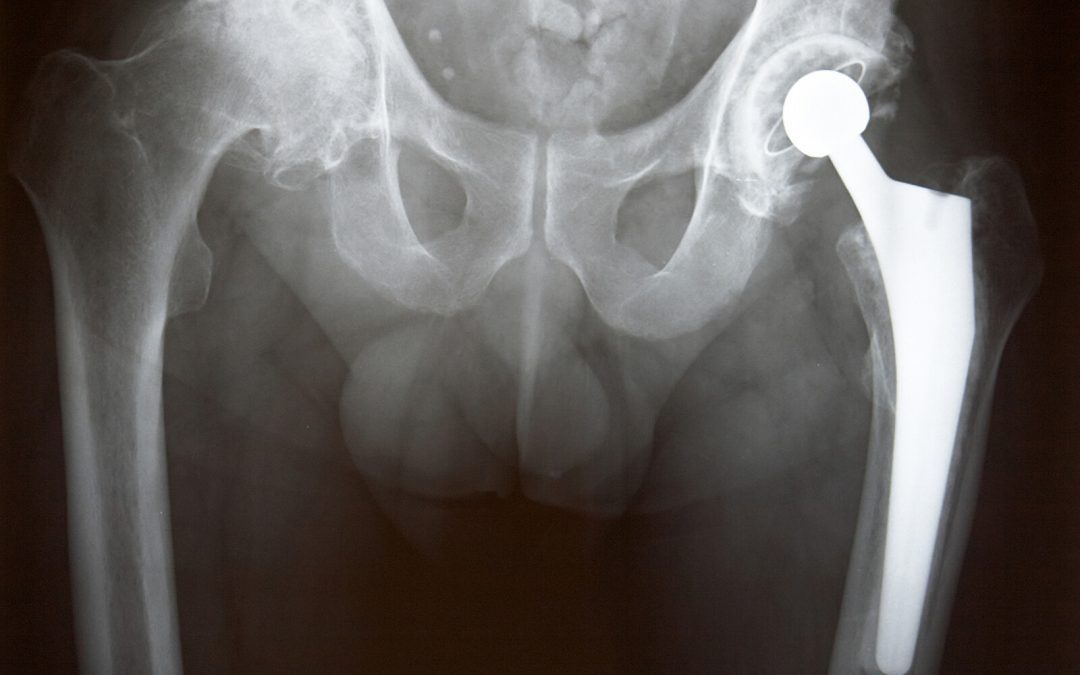 Faulty Hip Replacement Devices